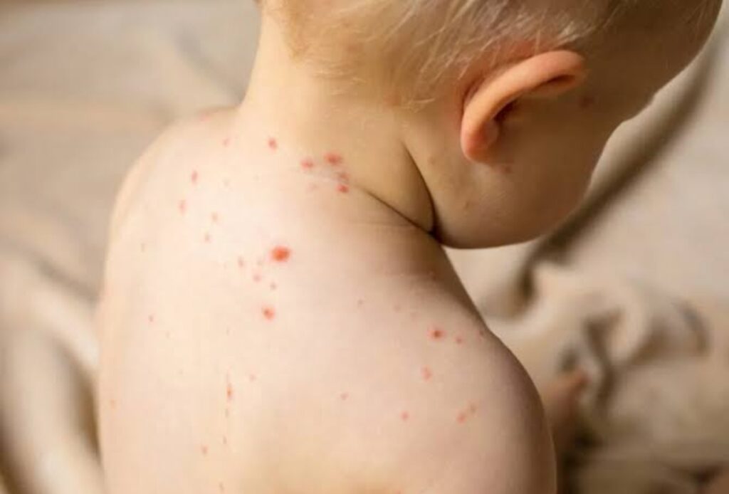 In an undated stock photo, a young girl is seen with measles on her neck