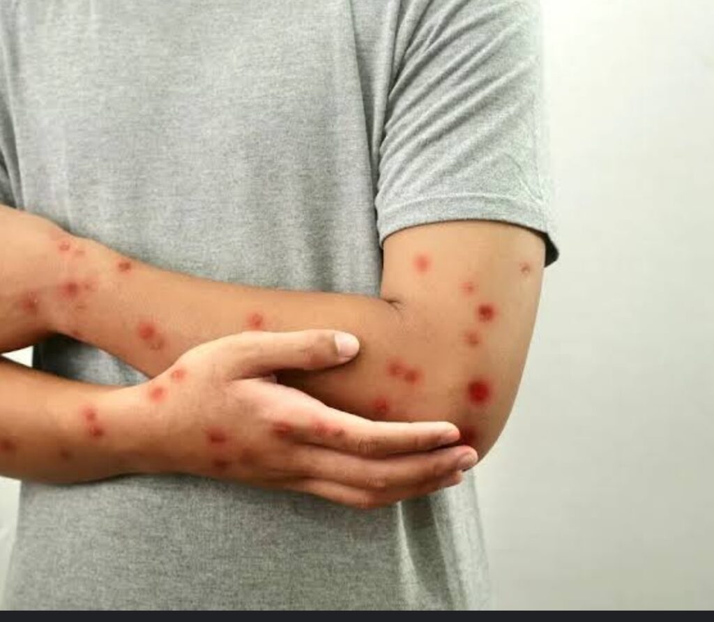 In an undated stock photo, a young girl is seen with measles on his hand