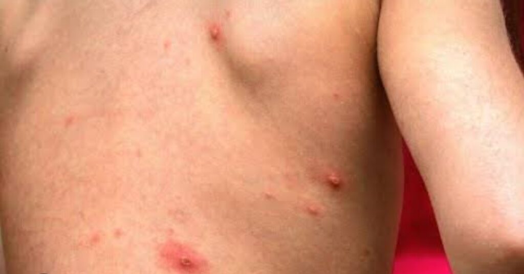 In an undated stock photo, a young girl is seen with measles on her back
